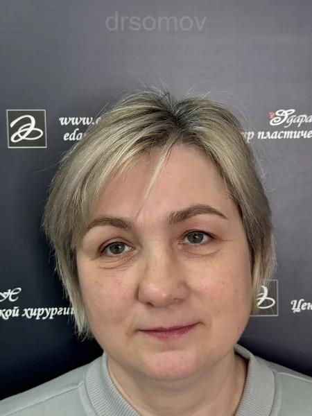 Верхняя и нижняя блефаропластика: до операции