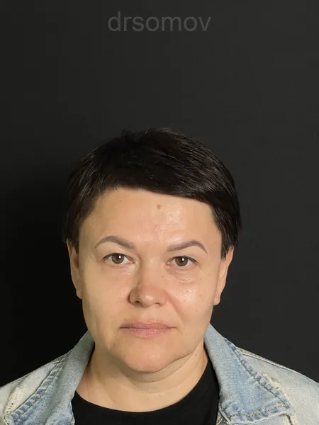 Верхняя блефаропластика: до операции