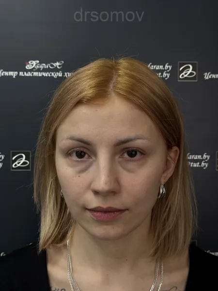 Трансконъюнктивальная блефаропластика: до операции