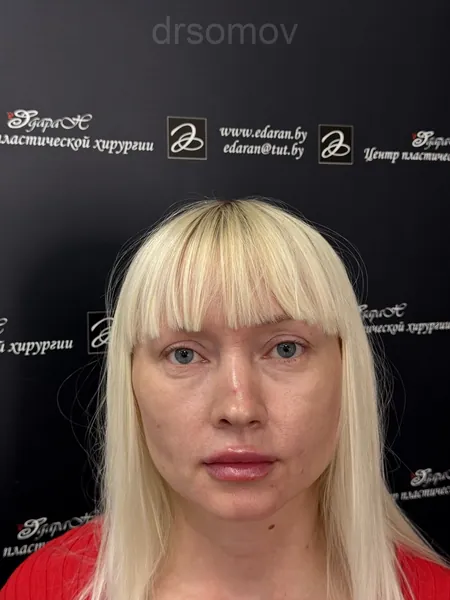 Эндоскопическая подтяжка лба: до операции